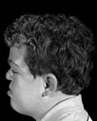 Apert Syndrome Before and After Pictures Dallas, TX
