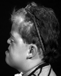 Apert Syndrome Before and After Pictures Dallas, TX
