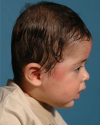 Craniosynostosis Before and After Pictures Dallas, TX