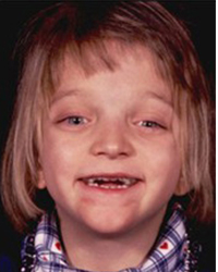 Crouzon Syndrome Before and After Pictures Dallas, TX