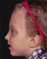 Crouzon Syndrome Before and After Pictures Dallas, TX