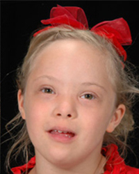 Down Syndrome Before and After Pictures Dallas, TX