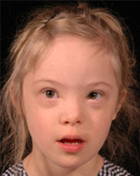 Down Syndrome Before and After Pictures Dallas, TX
