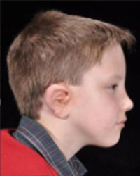 Ear Deformities/Microtia Before and After Pictures Dallas, TX