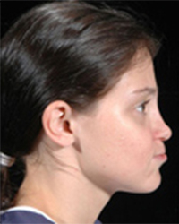 Jaw Deformity Before and After Pictures Dallas, TX