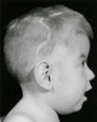 Muenke Syndrome Before and After Pictures Dallas, TX