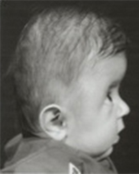 Muenke Syndrome Before and After Pictures Dallas, TX
