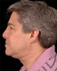 Nasal Deformity Before and After Pictures Dallas, TX