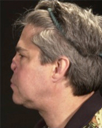 Nasal Deformity Before and After Pictures Dallas, TX
