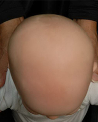 Plagiocephaly Before and After Pictures Dallas, TX