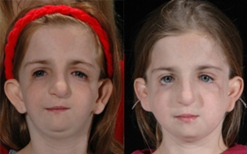 Treacher Collins Syndrome Before & After Pictures Dallas, Plano, TX