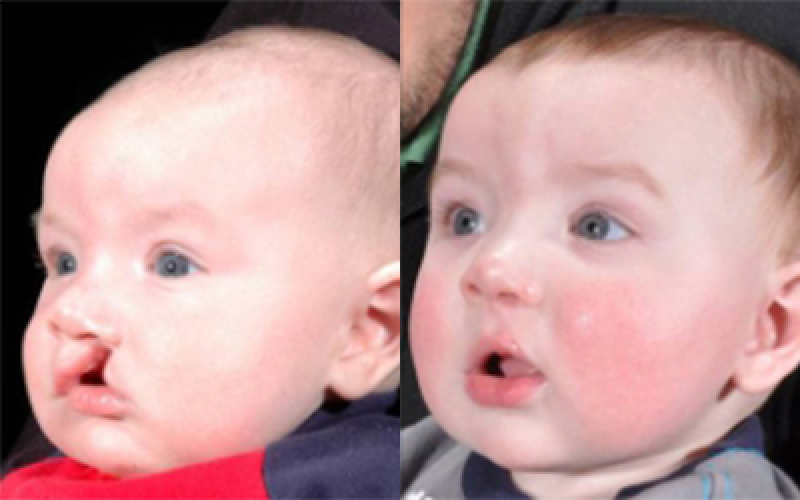 Unilateral Cleft Lip Palate Before And After Pictures In Dallas Tx