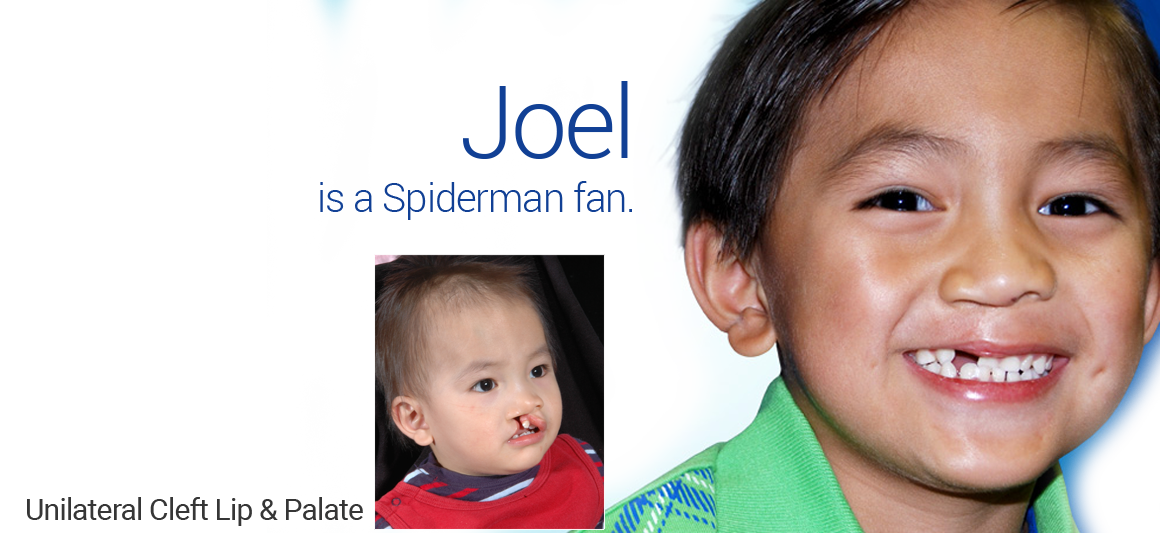 Bilateral Cleft Lip/Palate in Dallas, TX