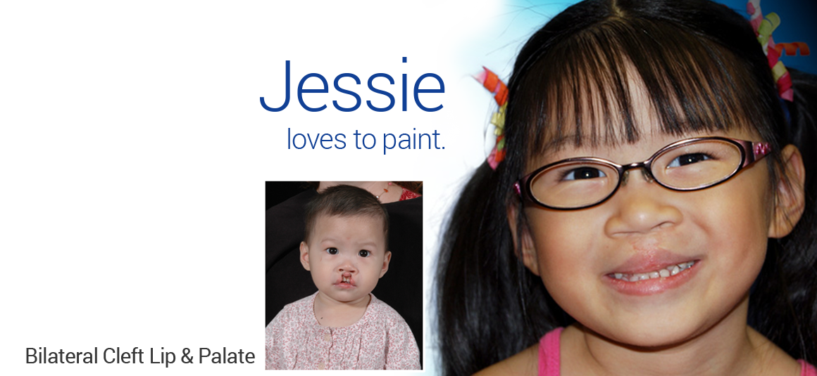 Bilateral Cleft Lip/Palate in Dallas, TX