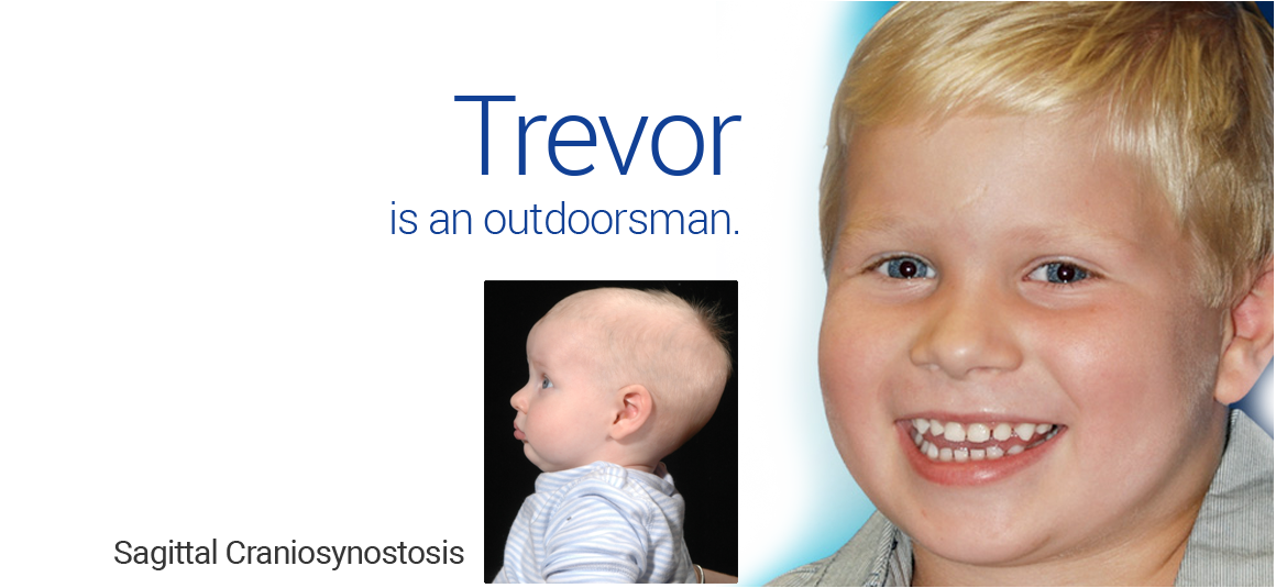 Bilateral Cleft Lip/Palate in Dallas, TX