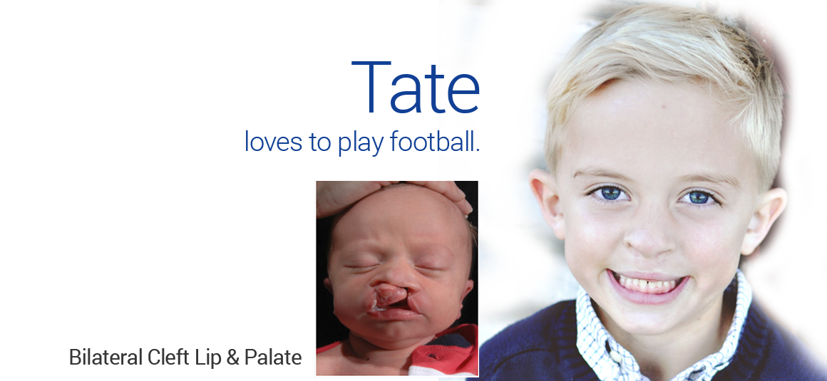 Bilateral Cleft Lip/Palate in Dallas, TX