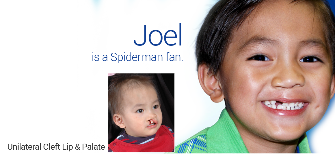 Bilateral Cleft Lip/Palate in Dallas, TX