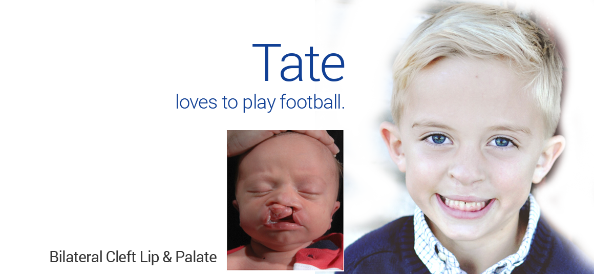 Bilateral Cleft Lip/Palate in Dallas, TX