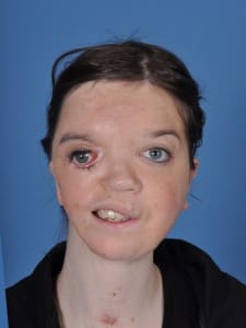 Goldenhar Syndrome Treatment Before and After Pictures Dallas, TX